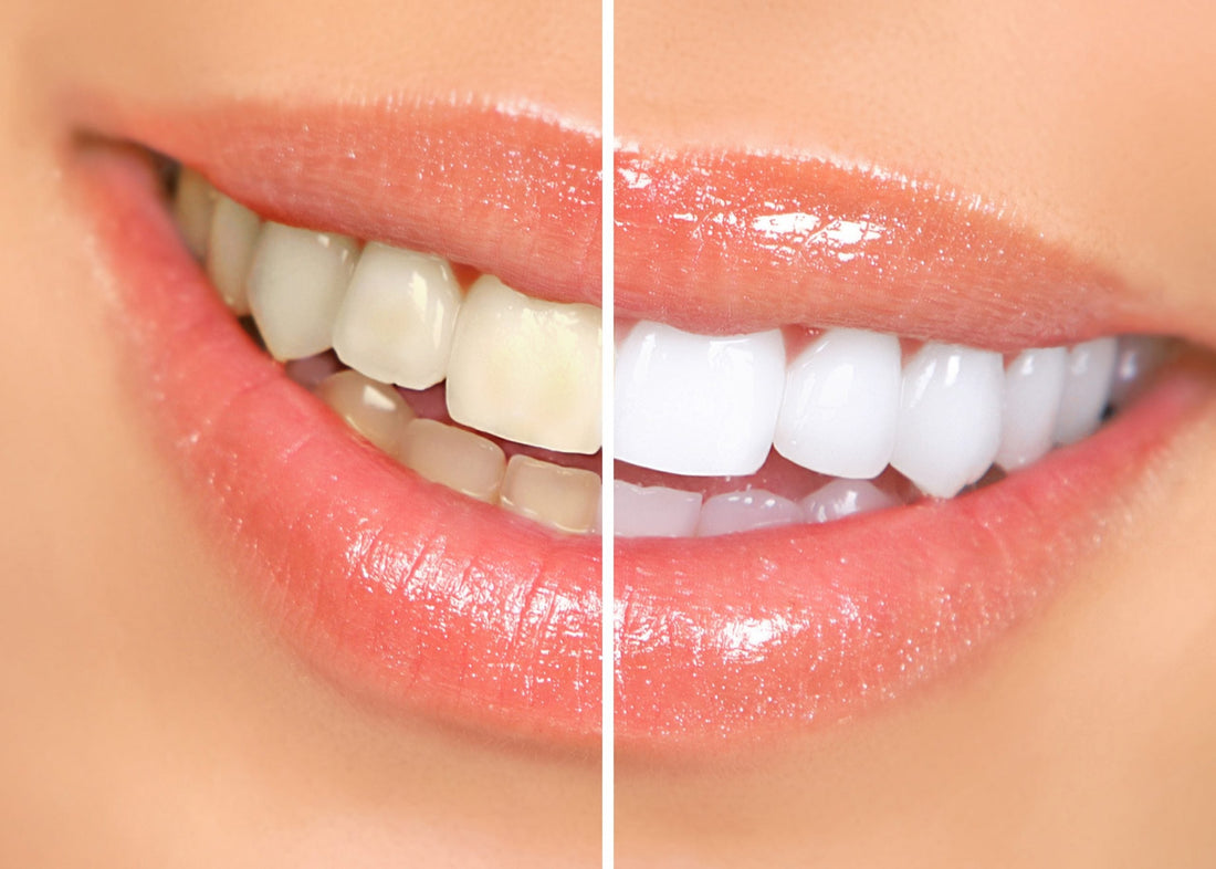 Blanchiment dentaire et strass : peut-on combiner les deux prestations ?