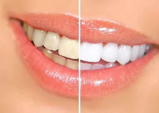 Blanchiment dentaire et strass : peut-on combiner les deux prestations ?
